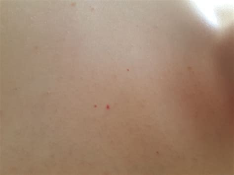 Petechien sind kleinste, punktförmige bis stecknadelkopfgroße blutungen. Kleine rote Blutpünktchen auf Oberarm und Rücken? (Gesundheit, Krankheit)