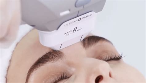 Ultraformer Wrinkle Treatment At Cheshire Lasers Middlewich