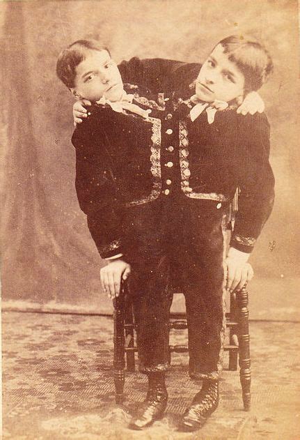7 Most Incredible Siamese Twins In History Conjoined Twins Human