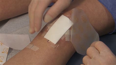 How To Apply Dressing After Knee Surgery Knee Arthroscopy Post