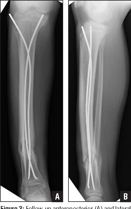 Figure 3 From Outcomes Using Titanium Elastic Nails For Open And Closed