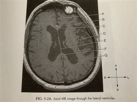 Fig 5 24 Axial Mr Image Through The Lateral Ventricles Diagram Quizlet