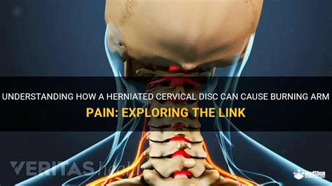 Understanding How A Herniated Cervical Disc Can Cause Burning Arm Pain