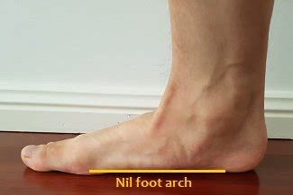 Flat feet are also known as fallen arches. How to fix Flat Feet (Pes planus) - Posture Direct
