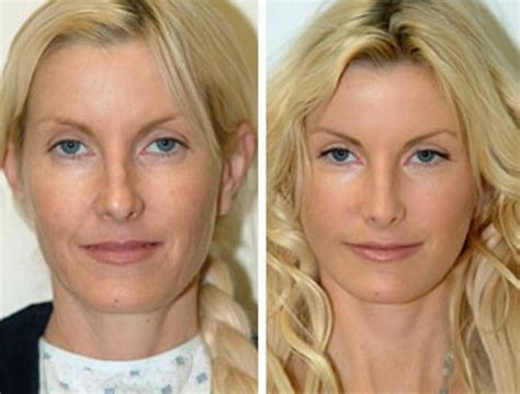 Some Best Methods Of Face Lift Without Surgery Be Beauty Tips
