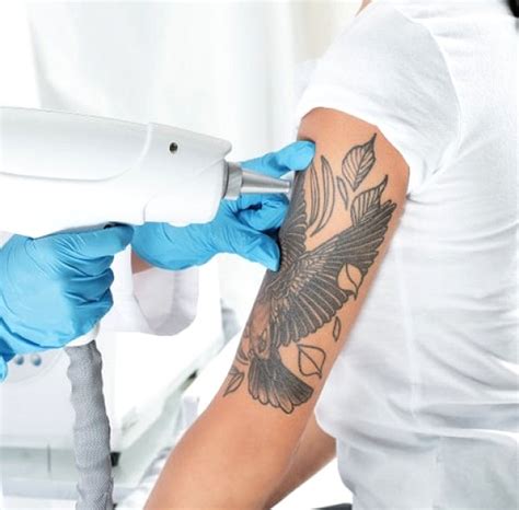 Laser Tattoo Removal Singapore Remove Permanent Tattoo V Medical