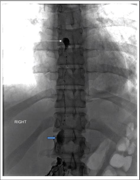 Figure 1 From Bilateral Traumatic Chylothorax Treated By Thoracic Duct