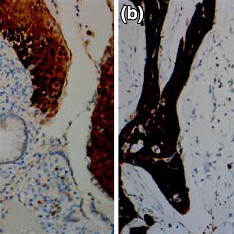 A P16 Immunohistochemical Expression In High Grade Cervical