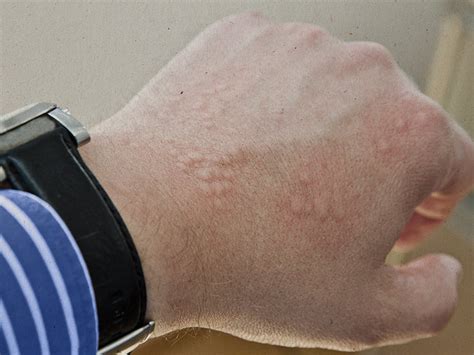 Rashes That Look Like Scabies Causes Symptoms And Treatment Medical News Today