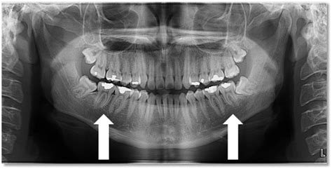 Radiographic Quality Evaluation: Ideal Pantomograph - Dr ...