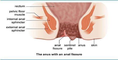 Crohns Disease And Anal Fissures New Sex Images Comments 3