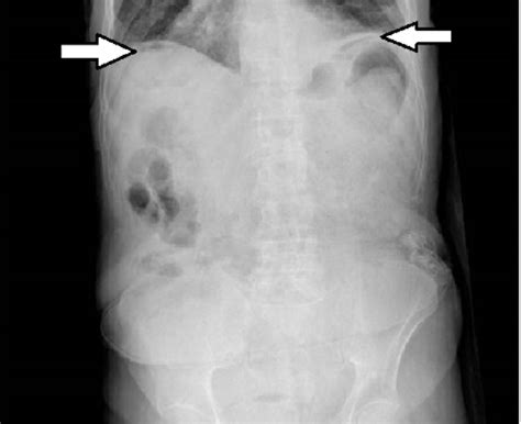 Supine Abdominal X Ray With High Suspicion Of Free Air Under The