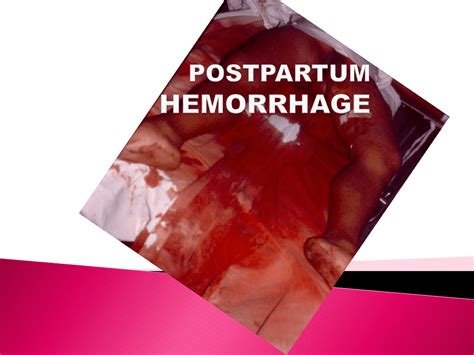 Postpartum Hemorrhage Hot Sex Picture