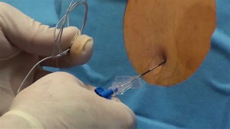 Epidural Steroid Injection Youtube