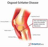 Pictures of Osgood Schlatter Exercises