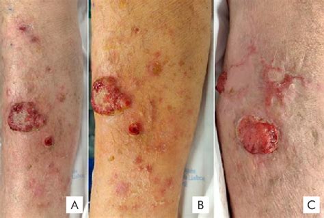 Multiple Erythematous And Violaceous Papulonodules Covered With