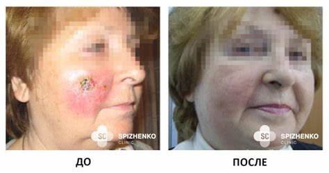 Рак кожи лечение диетой Рак кожи - Лечение опухолей кожи - Симптомы и диагностика - Киев Рак кожи - Лечение опухолей кожи - Симптомы и диагностика - Киев Рак кожи лечение диетой