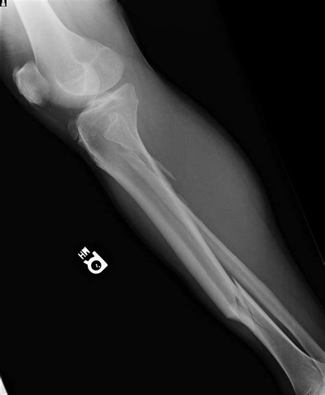 Broken Leg 2nd X Ray Biological Science Picture