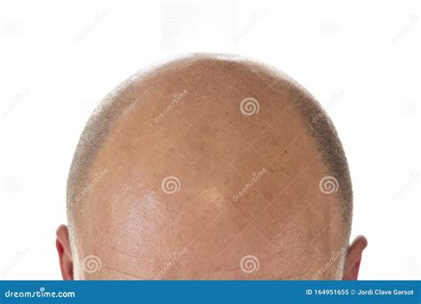 View Of Bald Man`s Head Stock Image Image Of Transplantation 164951655