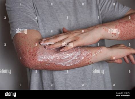 Woman Applying Moisturizer To Skin With Psoriasis With Her Hand On Her