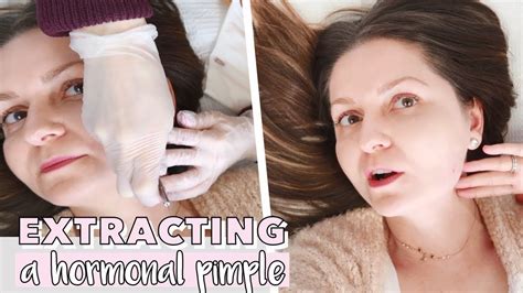 Vlog Extracting My Premenstrual Breakout And Tips For Hormonal Acne