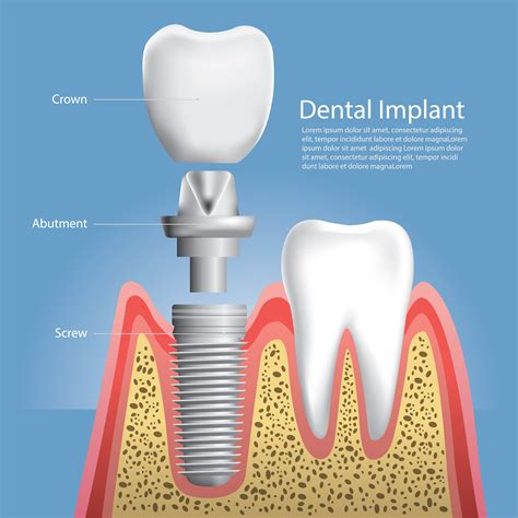Human Teeth And Dental Implant Vector Illustration 641348 Vector Art At