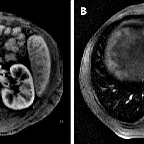 Liver Magnetic Resonance Imaging With Hepatobiliary Contrast Arterial