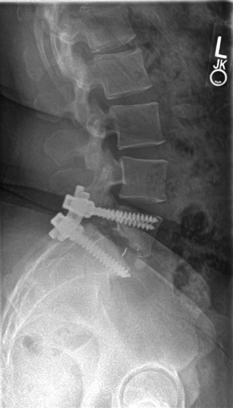Adult Isthmic Spondylolisthesis Spine Orthobullets