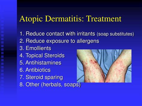 Ppt Atopic Dermatitis Powerpoint Presentation Free Download Id782987