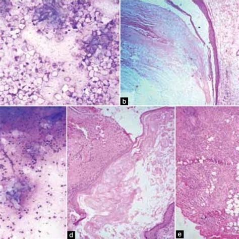 Pdf Epidermal Inclusion Cyst In Breast Is It So Rare