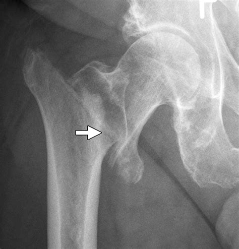 Proximal Femoral Fractures What The Orthopedic Surgeon Wants To Know