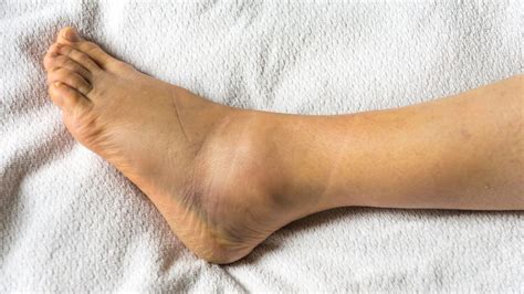 How To Prevent Sprained Ankles Ankle Sprain Prevention Tips