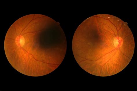 Deep Learning Enhanced Device Detects Diabetic Retinopathy Medical Bag