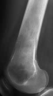 Fibrosarcoma of Bone - Pathology - Orthobullets