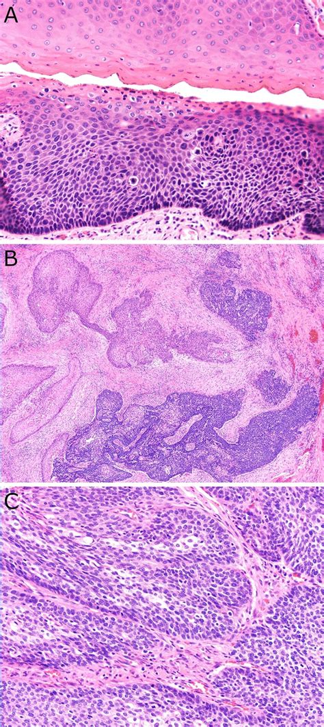 Morphologic Features Of Another Invasive Hpv Associated Scc With Scc In