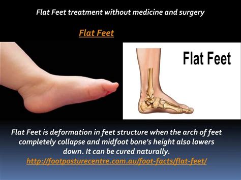 Ppt Flat Feet Treatment Without Medicine And Surgery Powerpoint Presentation Id7179043