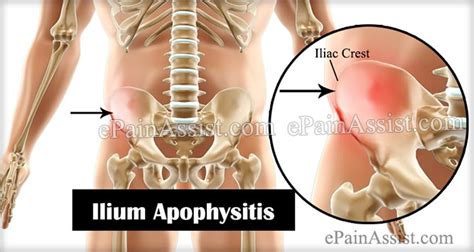 Ilium Apopysitis Guide To Know Its Causes Symptoms And Treatment