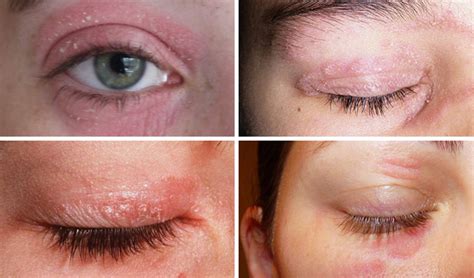 Treatment Psoriasis Eyelids Psoriasis Expert