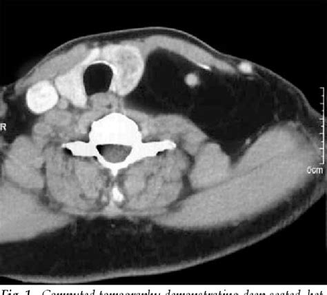 Figure 1 From Giant Cervical Lipoma Invading Carotid Artery A Case