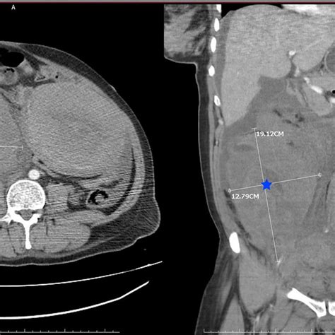 The Abdominal Computed Tomography Showed A 19 × 15 × 13 Cm Hematoma In Download Scientific