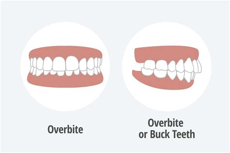 Do You Need Braces If You Have An Overbite The Brace Place