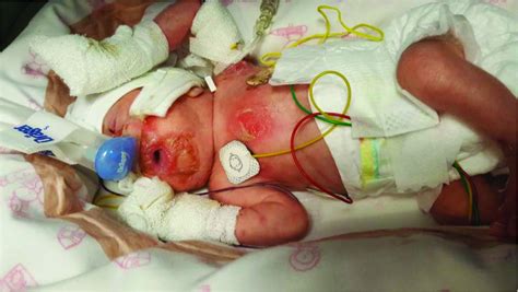 Staphylococcal Scalded Skin Syndrome In An Extremely Preterm Newborn