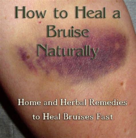 How To Heal A Bruise Naturally — Info You Should Know