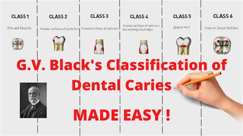 Gv Blacks Classification Of Dental Caries Quick And Complete
