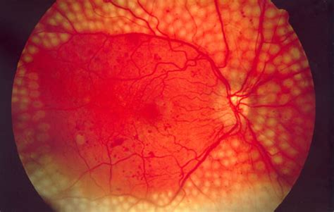 medical pictures info macular degeneration
