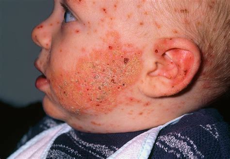 Chickenpox And Eczema On The Face Of A Baby Boy Photograph By Dr P