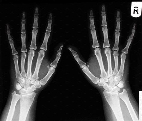 Xray Of A Healthy 30 Year Old Female Left And Right Hand Health