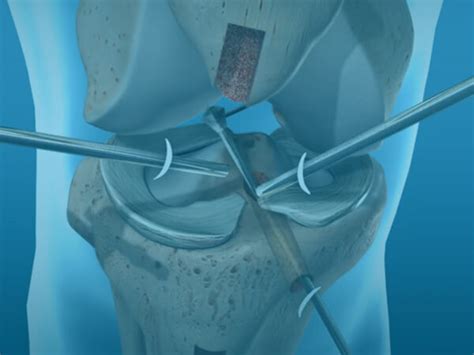 Acl Reconstruction Surgery At 1 Orthopedic Hospital In Omaha