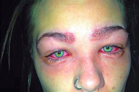 Teen Nearly Blinded And Left Looking Like A Frog After Horrific