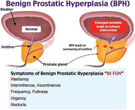 Benign Prostatic Hypertrophy Icd 10